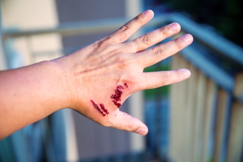 Glendale dog bite injury lawyers